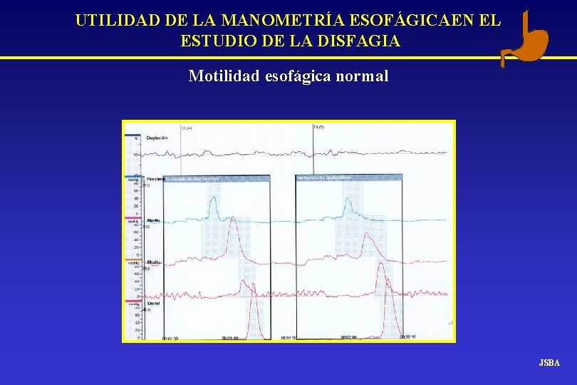 UTILIDAD DE LA MANOMETRÍA ESOFÁGICAEN EL ESTUDIO DE LA DISFAGIA Motilidad esofágica normal JSBA UTILIDAD DE LA MANOMETRÍA ESOFÁGICAEN EL ESTUDIO DE LA DISFAGIA Motilidad esofágica normal JSBA