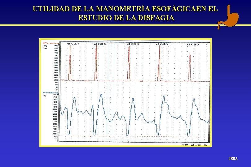 UTILIDAD DE LA MANOMETRÍA ESOFÁGICAEN EL ESTUDIO DE LA DISFAGIA JSBA UTILIDAD DE LA MANOMETRÍA ESOFÁGICAEN EL ESTUDIO DE LA DISFAGIA JSBA