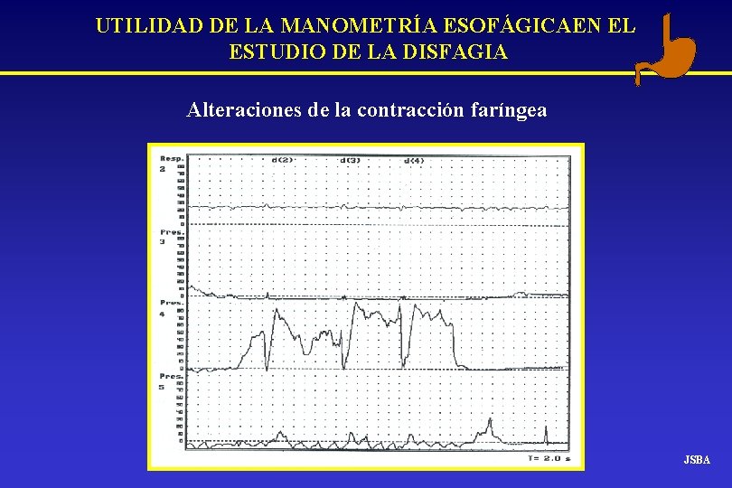 UTILIDAD DE LA MANOMETRÍA ESOFÁGICAEN EL ESTUDIO DE LA DISFAGIA Alteraciones de la contracción UTILIDAD DE LA MANOMETRÍA ESOFÁGICAEN EL ESTUDIO DE LA DISFAGIA Alteraciones de la contracción