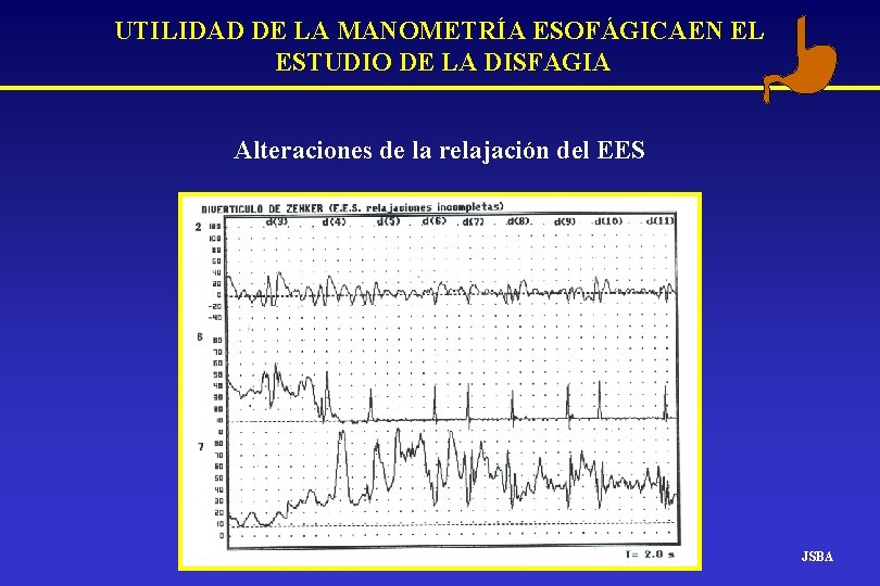 UTILIDAD DE LA MANOMETRÍA ESOFÁGICAEN EL ESTUDIO DE LA DISFAGIA Alteraciones de la relajación UTILIDAD DE LA MANOMETRÍA ESOFÁGICAEN EL ESTUDIO DE LA DISFAGIA Alteraciones de la relajación