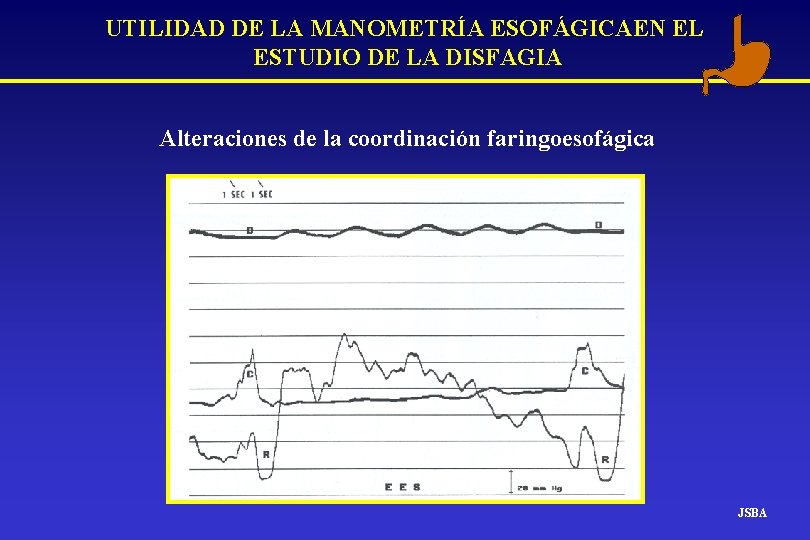 UTILIDAD DE LA MANOMETRÍA ESOFÁGICAEN EL ESTUDIO DE LA DISFAGIA Alteraciones de la coordinación UTILIDAD DE LA MANOMETRÍA ESOFÁGICAEN EL ESTUDIO DE LA DISFAGIA Alteraciones de la coordinación