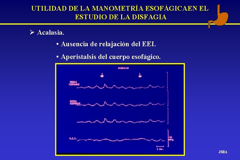 UTILIDAD DE LA MANOMETRÍA ESOFÁGICAEN EL ESTUDIO DE LA DISFAGIA Ø Acalasia. • Ausencia UTILIDAD DE LA MANOMETRÍA ESOFÁGICAEN EL ESTUDIO DE LA DISFAGIA Ø Acalasia. • Ausencia