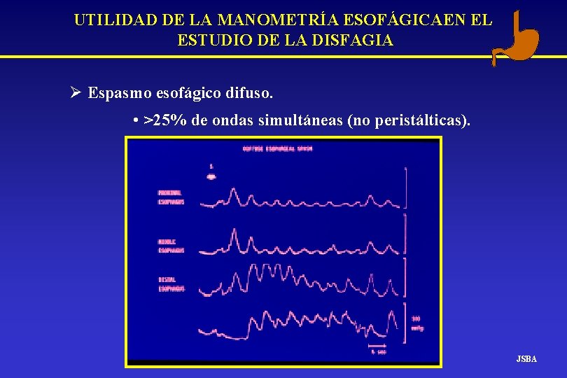 UTILIDAD DE LA MANOMETRÍA ESOFÁGICAEN EL ESTUDIO DE LA DISFAGIA Ø Espasmo esofágico difuso. UTILIDAD DE LA MANOMETRÍA ESOFÁGICAEN EL ESTUDIO DE LA DISFAGIA Ø Espasmo esofágico difuso.