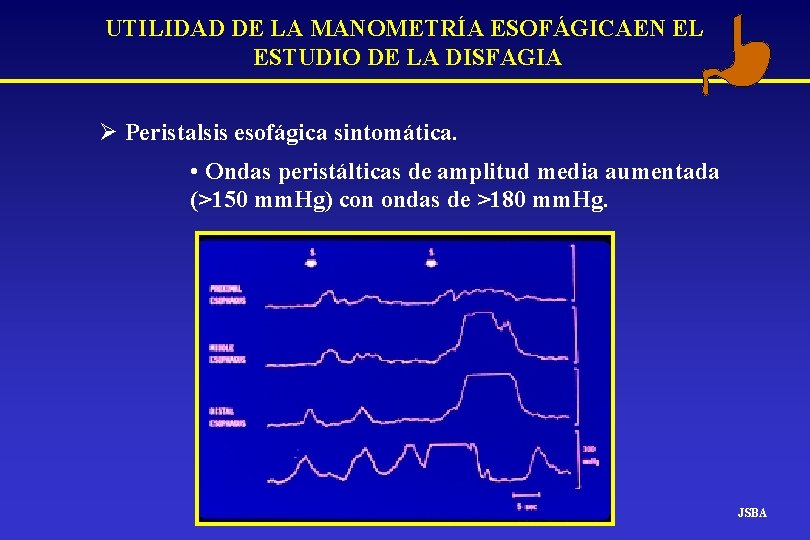 UTILIDAD DE LA MANOMETRÍA ESOFÁGICAEN EL ESTUDIO DE LA DISFAGIA Ø Peristalsis esofágica sintomática. UTILIDAD DE LA MANOMETRÍA ESOFÁGICAEN EL ESTUDIO DE LA DISFAGIA Ø Peristalsis esofágica sintomática.