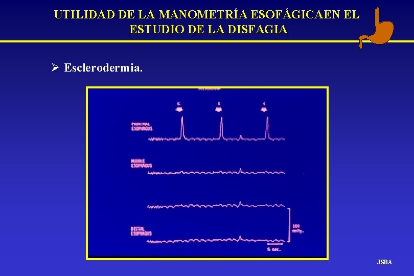 UTILIDAD DE LA MANOMETRÍA ESOFÁGICAEN EL ESTUDIO DE LA DISFAGIA Ø Esclerodermia. JSBA UTILIDAD DE LA MANOMETRÍA ESOFÁGICAEN EL ESTUDIO DE LA DISFAGIA Ø Esclerodermia. JSBA
