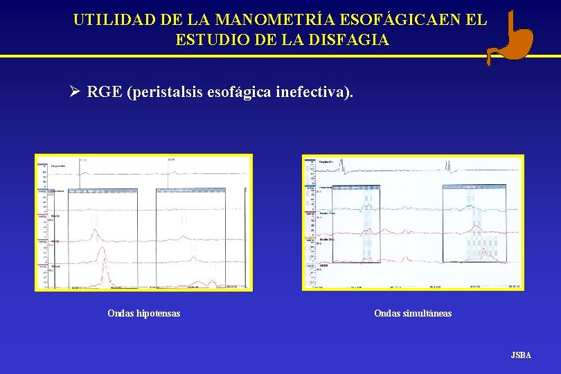 UTILIDAD DE LA MANOMETRÍA ESOFÁGICAEN EL ESTUDIO DE LA DISFAGIA Ø RGE (peristalsis esofágica UTILIDAD DE LA MANOMETRÍA ESOFÁGICAEN EL ESTUDIO DE LA DISFAGIA Ø RGE (peristalsis esofágica
