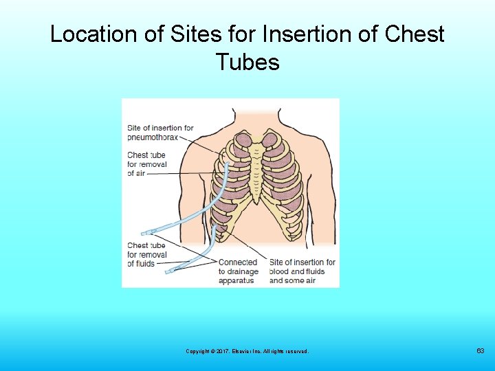 Location of Sites for Insertion of Chest Tubes Copyright © 2017, Elsevier Inc. All