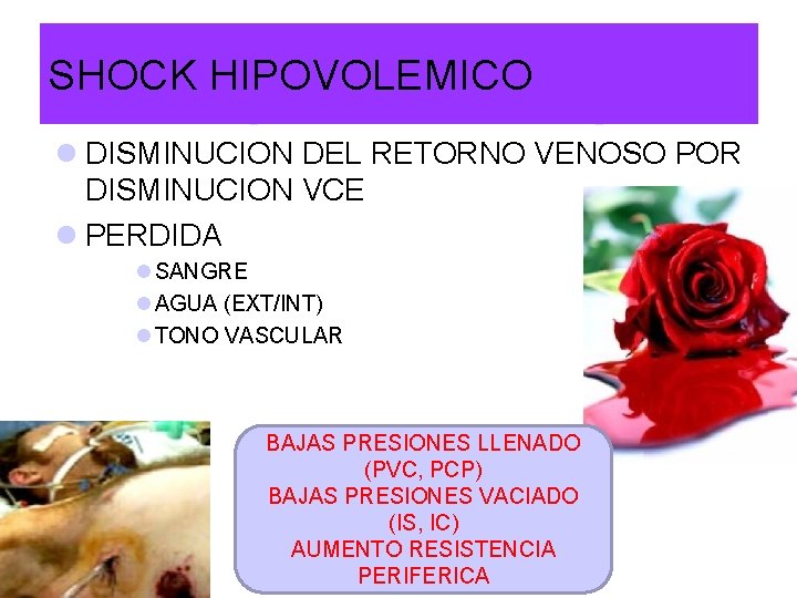 SHOCK HIPOVOLEMICO l DISMINUCION DEL RETORNO VENOSO POR DISMINUCION VCE l PERDIDA l SANGRE SHOCK HIPOVOLEMICO l DISMINUCION DEL RETORNO VENOSO POR DISMINUCION VCE l PERDIDA l SANGRE