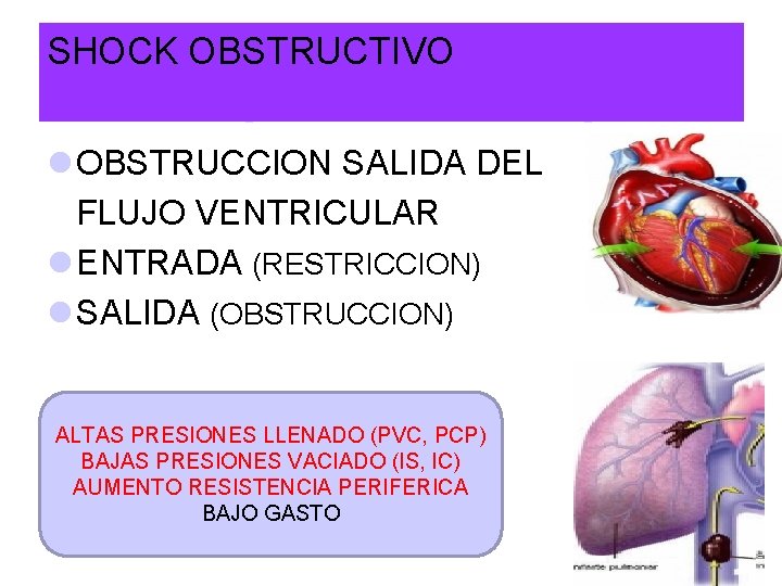 SHOCK OBSTRUCTIVO l OBSTRUCCION SALIDA DEL FLUJO VENTRICULAR l ENTRADA (RESTRICCION) l SALIDA (OBSTRUCCION)