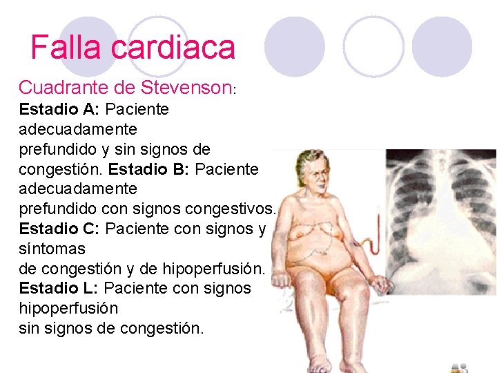 Falla cardiaca Cuadrante de Stevenson: Estadio A: Paciente adecuadamente prefundido y sin signos de