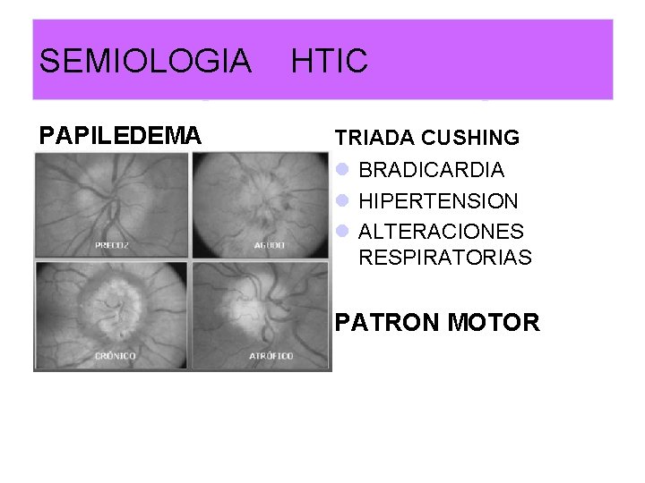 SEMIOLOGIA HTIC PAPILEDEMA TRIADA CUSHING l BRADICARDIA l HIPERTENSION l ALTERACIONES RESPIRATORIAS PATRON MOTOR