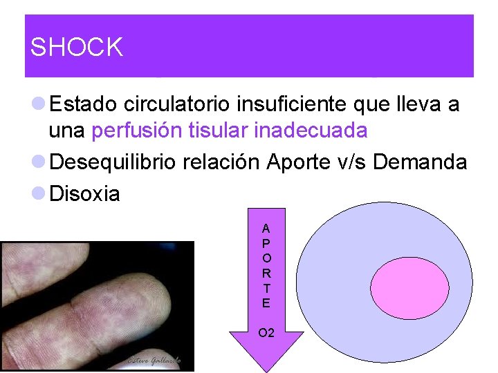 SHOCK l Estado circulatorio insuficiente que lleva a una perfusión tisular inadecuada l Desequilibrio