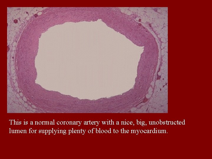 This is a normal coronary artery with a nice, big, unobstructed lumen for supplying