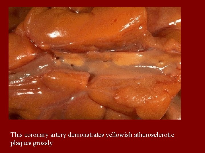 This coronary artery demonstrates yellowish atherosclerotic plaques grossly 