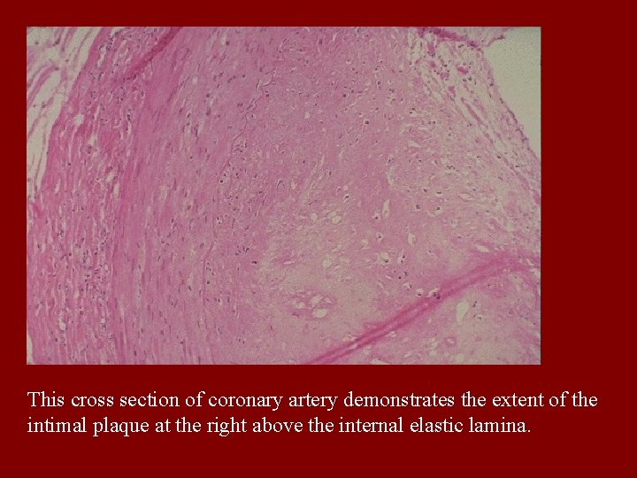 This cross section of coronary artery demonstrates the extent of the intimal plaque at