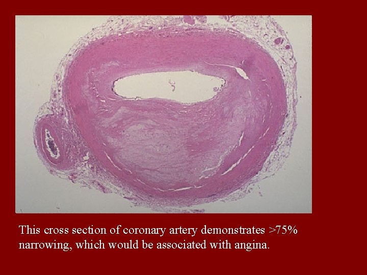 This cross section of coronary artery demonstrates >75% narrowing, which would be associated with