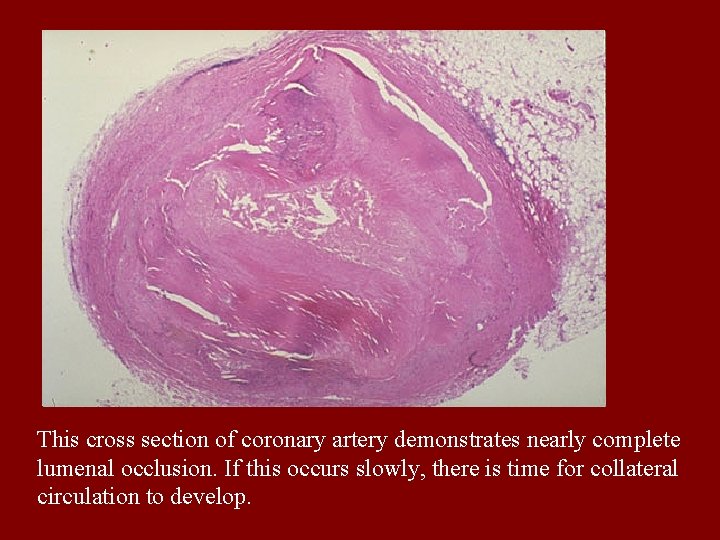 This cross section of coronary artery demonstrates nearly complete lumenal occlusion. If this occurs