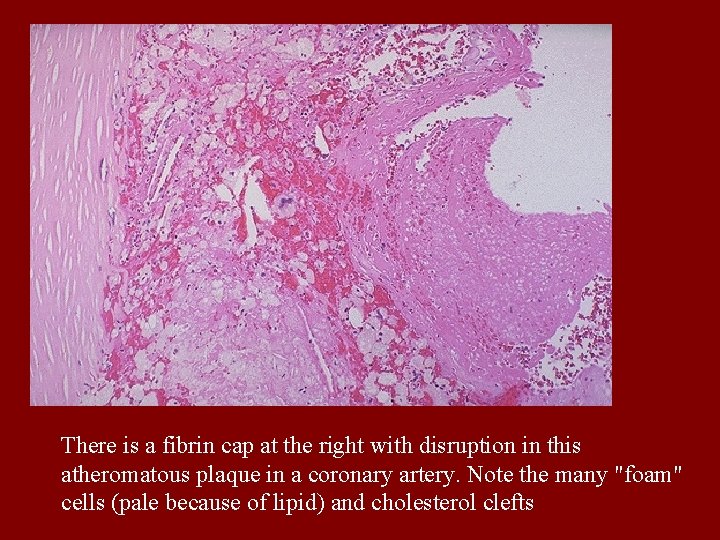 There is a fibrin cap at the right with disruption in this atheromatous plaque