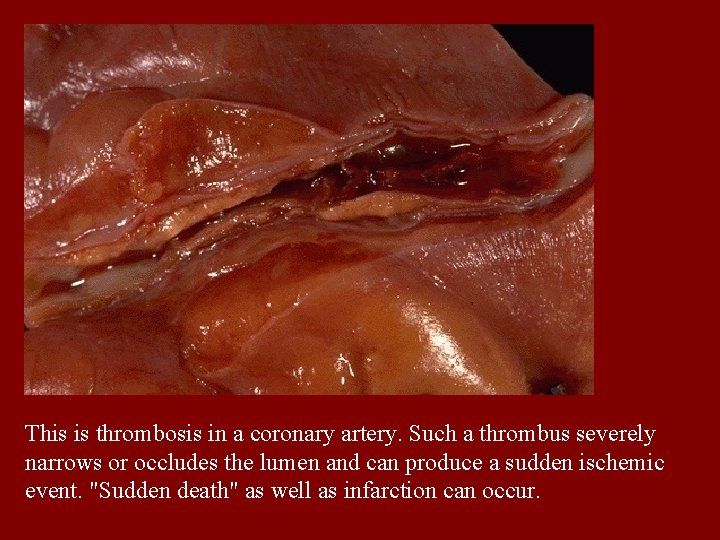 This is thrombosis in a coronary artery. Such a thrombus severely narrows or occludes