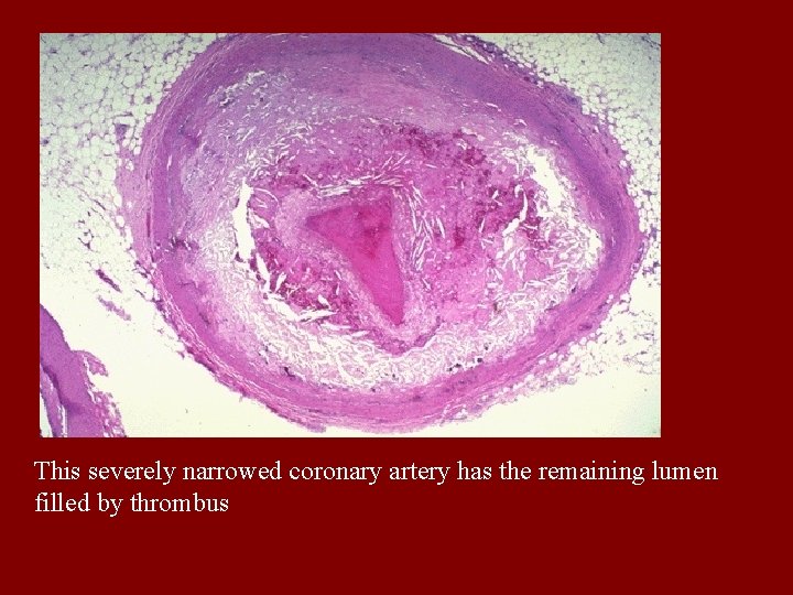 This severely narrowed coronary artery has the remaining lumen filled by thrombus 
