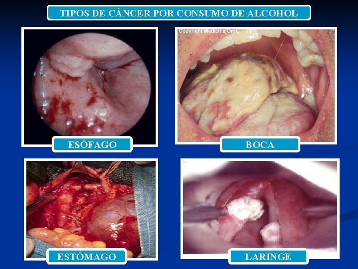 TIPOS DE CÁNCER POR CONSUMO DE ALCOHOL ESÓFAGO ESTÓMAGO BOCA LARINGE 