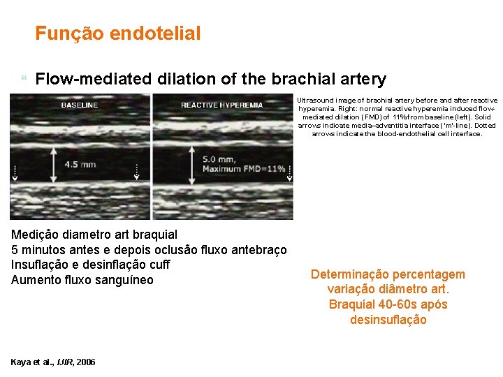 Função endotelial Flow-mediated dilation of the brachial artery Ultrasound image of brachial artery before