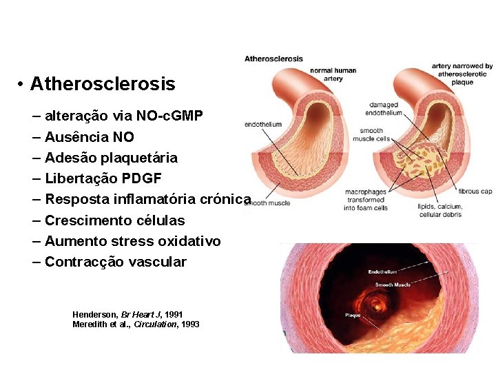  • Atherosclerosis – alteração via NO-c. GMP – Ausência NO – Adesão plaquetária