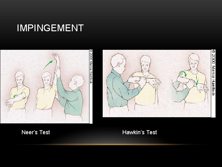 IMPINGEMENT Neer’s Test Hawkin’s Test 