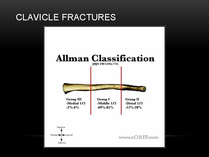 CLAVICLE FRACTURES 