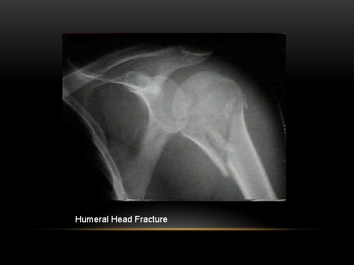 Humeral Head Fracture 