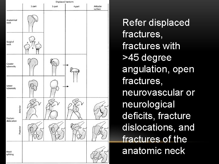 Refer displaced fractures, fractures with >45 degree angulation, open fractures, neurovascular or neurological deficits,