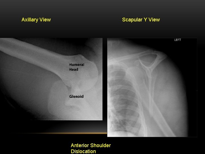 Axillary View Scapular Y View Anterior Shoulder Dislocation 