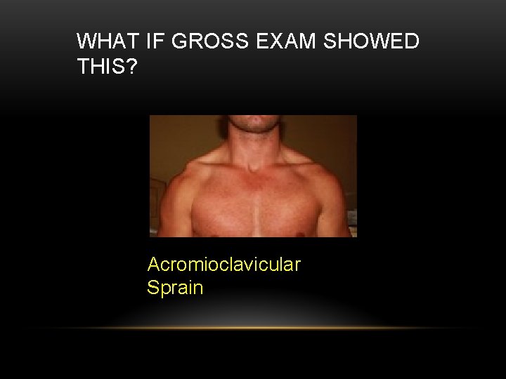 WHAT IF GROSS EXAM SHOWED THIS? Acromioclavicular Sprain 