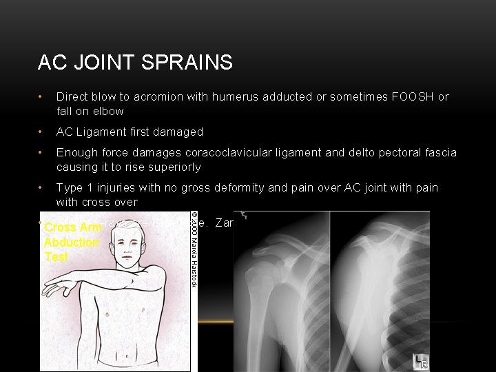 AC JOINT SPRAINS • Direct blow to acromion with humerus adducted or sometimes FOOSH