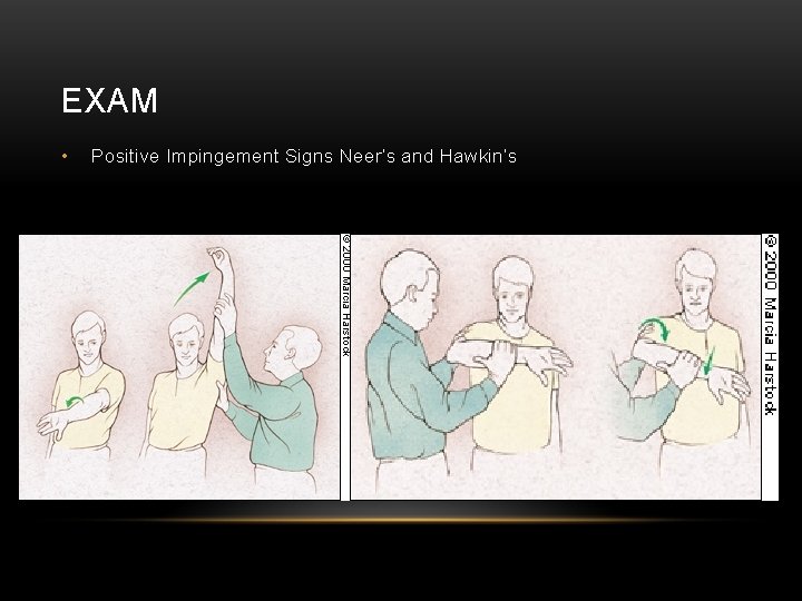 EXAM • Positive Impingement Signs Neer’s and Hawkin’s 