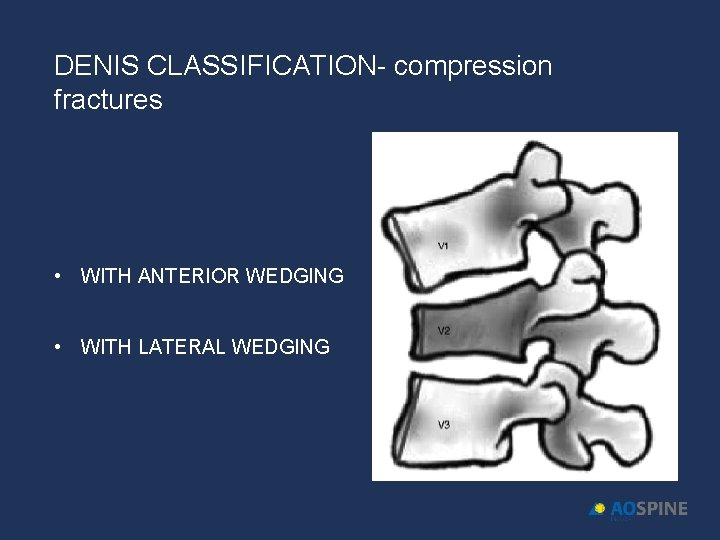 DENIS CLASSIFICATION- compression fractures • WITH ANTERIOR WEDGING • WITH LATERAL WEDGING 