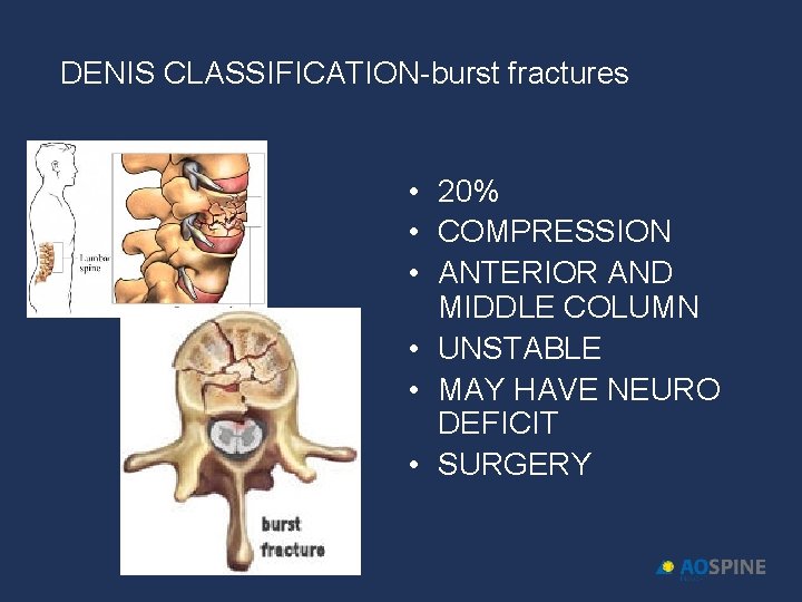 DENIS CLASSIFICATION-burst fractures • 20% • COMPRESSION • ANTERIOR AND MIDDLE COLUMN • UNSTABLE