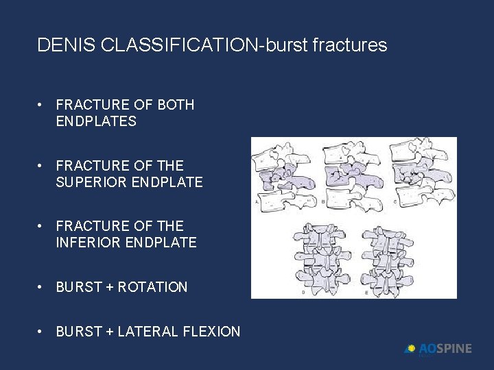 DENIS CLASSIFICATION-burst fractures • FRACTURE OF BOTH ENDPLATES • FRACTURE OF THE SUPERIOR ENDPLATE