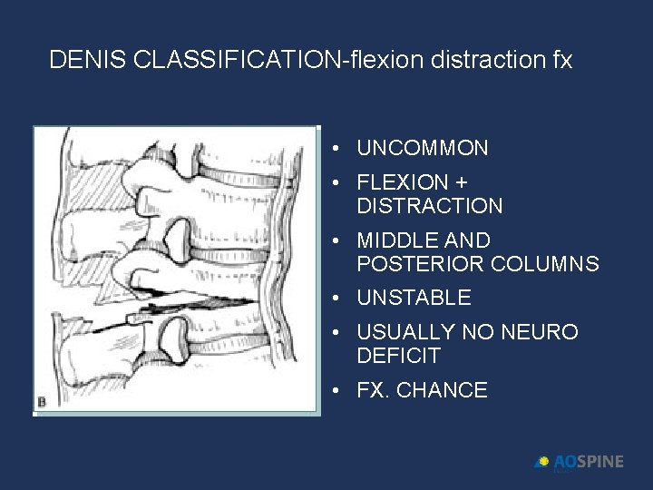 DENIS CLASSIFICATION-flexion distraction fx • UNCOMMON • FLEXION + DISTRACTION • MIDDLE AND POSTERIOR
