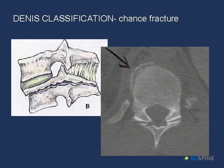 DENIS CLASSIFICATION- chance fracture 