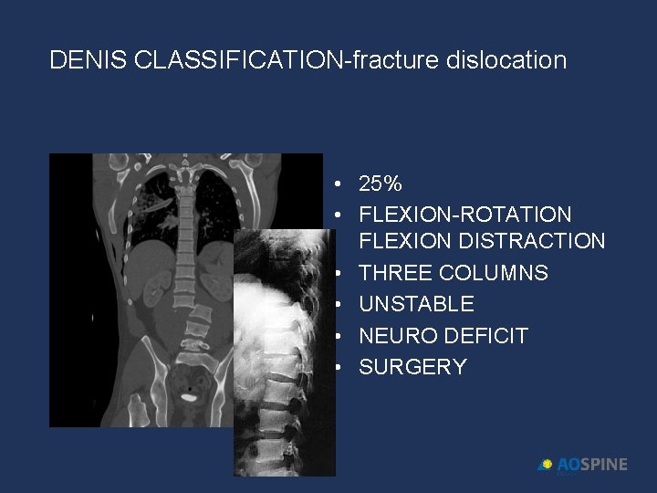 DENIS CLASSIFICATION-fracture dislocation • 25% • FLEXION-ROTATION FLEXION DISTRACTION • THREE COLUMNS • UNSTABLE