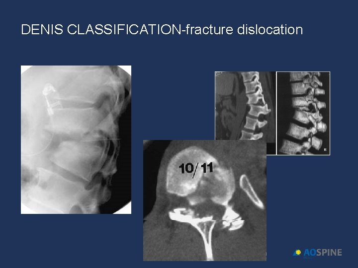 DENIS CLASSIFICATION-fracture dislocation 