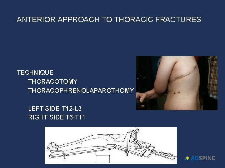 ANTERIOR APPROACH TO THORACIC FRACTURES TECHNIQUE THORACOTOMY THORACOPHRENOLAPAROTHOMY LEFT SIDE T 12 -L 3