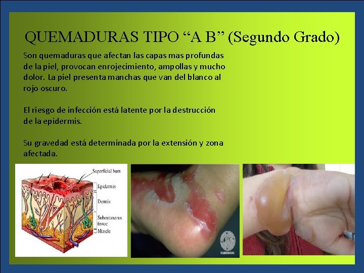 QUEMADURAS TIPO “A B” (Segundo Grado) Son quemaduras que afectan las capas mas profundas