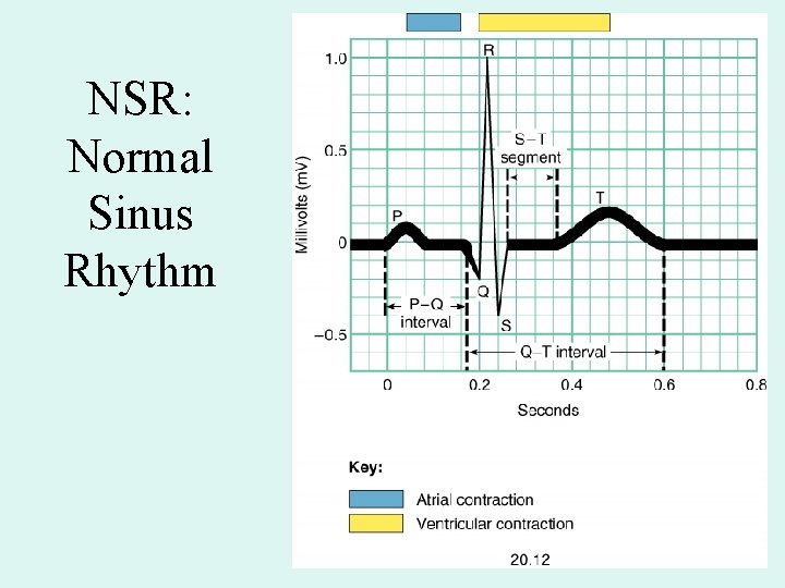NSR: Normal Sinus Rhythm NSR: Normal Sinus Rhythm