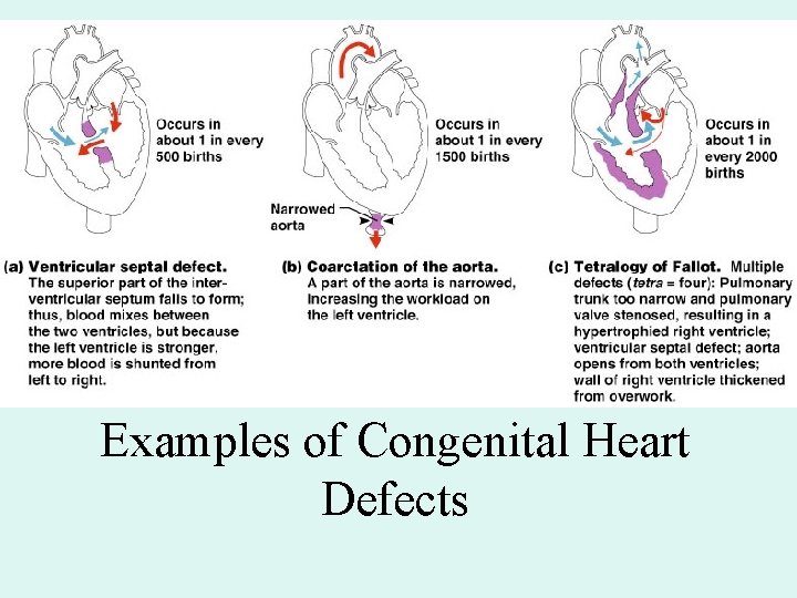 Examples of Congenital Heart Defects Examples of Congenital Heart Defects