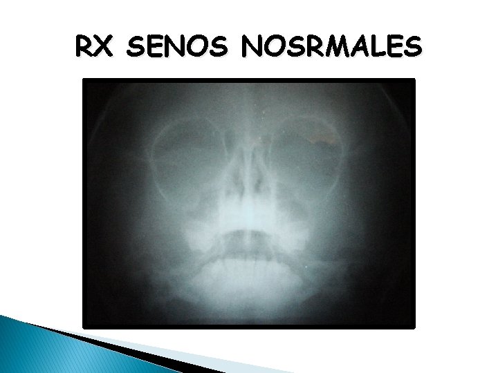 RX SENOS NOSRMALES 