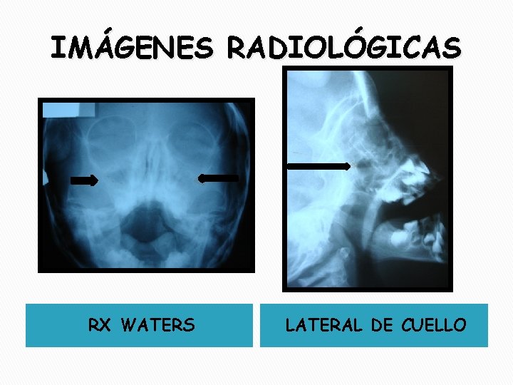 IMÁGENES RADIOLÓGICAS RX WATERS LATERAL DE CUELLO 