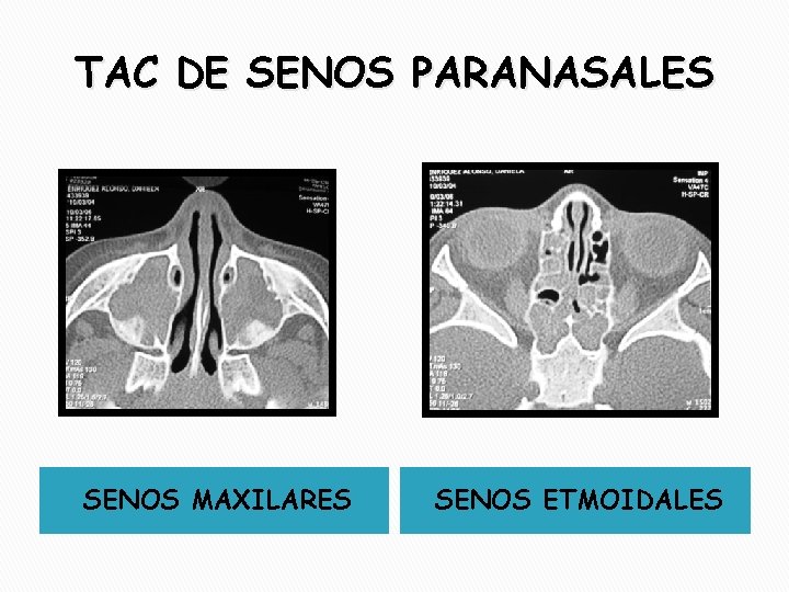 TAC DE SENOS PARANASALES SENOS MAXILARES SENOS ETMOIDALES 