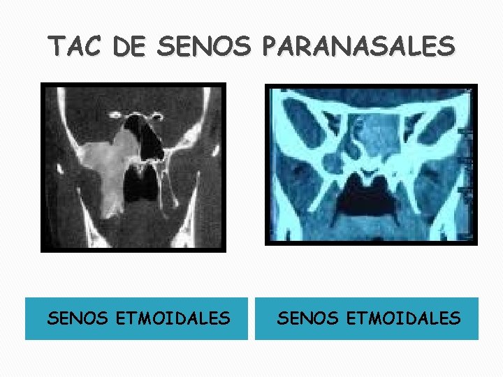 TAC DE SENOS PARANASALES SENOS ETMOIDALES 